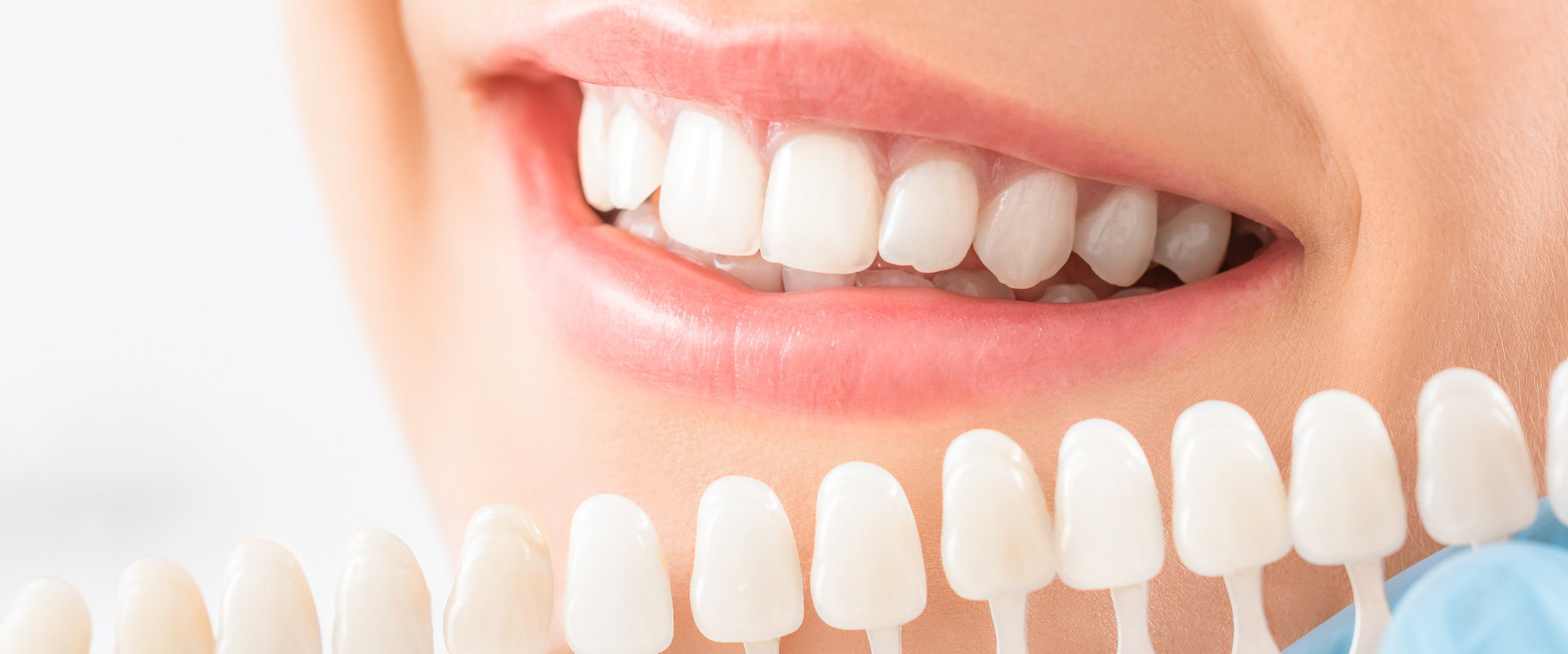 ホワイトニング